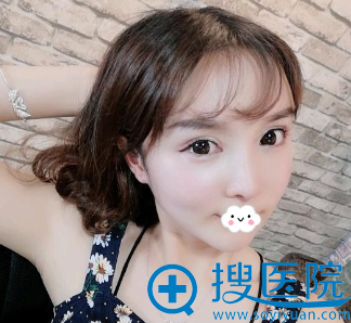 成都莱尹<!--<i data=20240710 data-id=16572></i>-->双眼皮失败修复术后效果图 成都莱尹<!--<i data=20240710 data-id=16572></i>-->双眼皮失败修复术后效果图