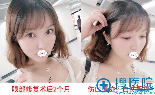 双眼皮失败修复哪家好?成都莱尹<!--<i data=20240710 data-id=16572></i>-->真人案例 双眼皮失败修复哪家好?成都莱尹<!--<i data=20240710 data-id=16572></i>-->真人案例