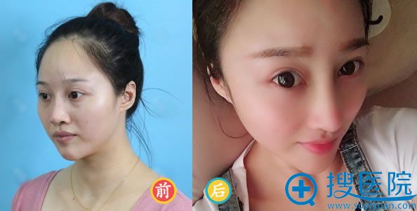 长沙华韩华美张涛鼻综合案例 长沙华韩华美张涛鼻综合案例