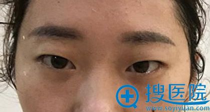 没有在郴州维纳斯做双眼皮手术前 没有在郴州维纳斯做双眼皮手术前