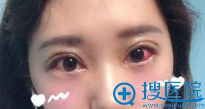 郴州维纳斯割双眼皮开内眼角术后第3天照片 郴州维纳斯割双眼皮开内眼角术后第3天照片