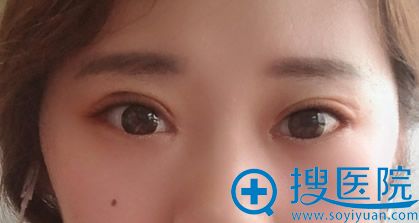 朱显国全切双眼皮+开内眼角术后24天恢复效果 朱显国全切双眼皮+开内眼角术后24天恢复效果