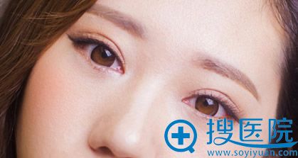 成郴州维纳斯割双眼皮+开内眼角术后50天效果图 成郴州维纳斯割双眼皮+开内眼角术后50天效果图