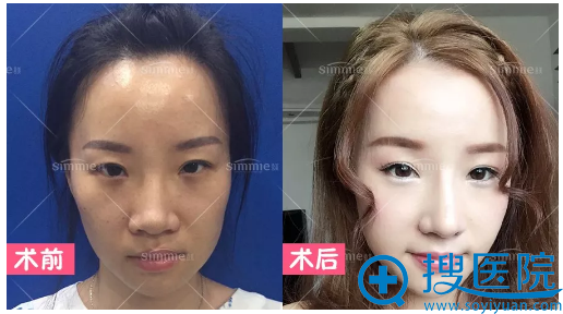 上海喜美鼻<!--<i data=20240710 data-id=16268></i>-->做的综合鼻翼缩小真人案例 上海喜美鼻<!--<i data=20240710 data-id=16268></i>-->做的综合鼻翼缩小真人案例