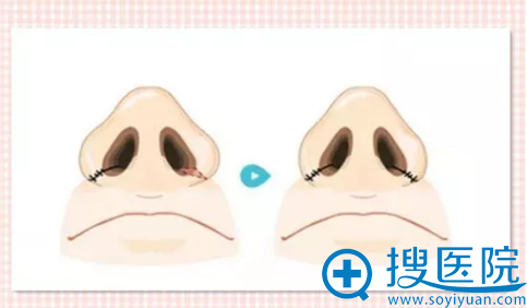 鼻翼缩小手术过程分解图 鼻翼缩小手术过程分解图
