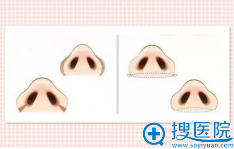 上海喜美鼻翼缩小手术方法 上海喜美鼻翼缩小手术方法