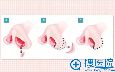 上海喜美鼻翼缩小步骤图 上海喜美鼻翼缩小步骤图