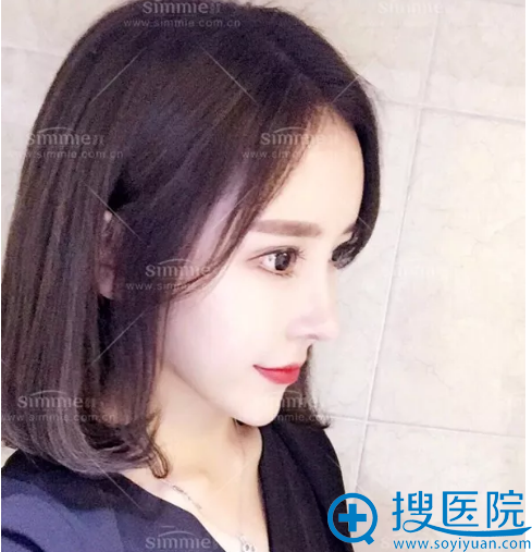 上海喜美鼻翼缩小案例图 上海喜美鼻翼缩小案例图