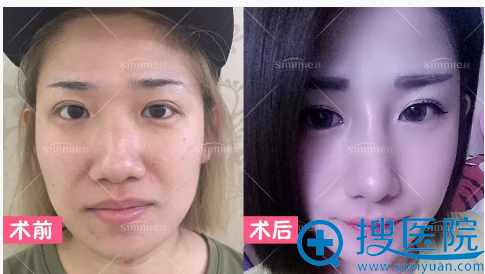 上海喜美<!--<i data=20240710 data-id=16268></i>-->做的鼻翼缩小案例图 上海喜美<!--<i data=20240710 data-id=16268></i>-->做的鼻翼缩小案例图