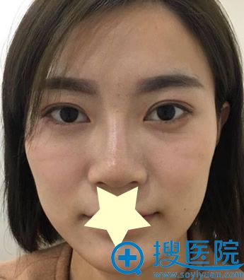 这真的是我在兰州时光整形做面部吸脂瘦脸+面部脂肪填充真实照