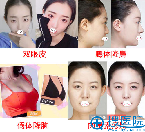 遵义韩美割双眼皮/隆鼻/隆胸案例效果图 遵义韩美割双眼皮/隆鼻/隆胸案例效果图