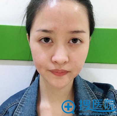 公开我去上海仁爱医院找鼻王赵克昶做隆鼻和脂肪填充的亲身经历