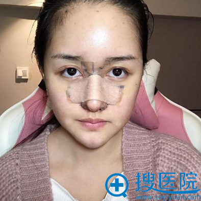 <!--<i data=20240710 data-id=11606></i>-->医院赵克昶隆鼻术后7天 <!--<i data=20240710 data-id=11606></i>-->医院赵克昶隆鼻术后7天