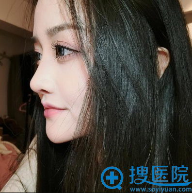 <!--<i data=20240710 data-id=11606></i>-->医院上海鼻王赵克昶做的隆鼻真人案例 <!--<i data=20240710 data-id=11606></i>-->医院上海鼻王赵克昶做的隆鼻真人案例