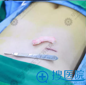 肋软骨隆鼻中肋骨取出手术切口示意图 肋软骨隆鼻中肋骨取出手术切口示意图