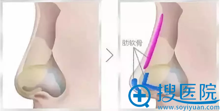肋软骨隆鼻示意图 肋软骨隆鼻示意图
