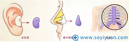 自体软骨隆鼻材料 自体软骨隆鼻材料