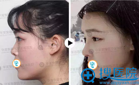 听别人说肋软骨隆鼻效果好,做个自体软骨隆鼻手术需要多少钱
