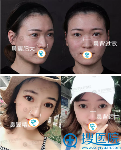 <!--<i data=20240710 data-id=13402></i>-->肋软骨隆鼻前后对比 <!--<i data=20240710 data-id=13402></i>-->肋软骨隆鼻前后对比