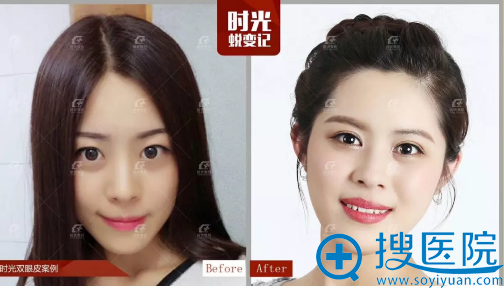 上海时光整形医院郑志玉做的双眼皮案例 上海时光整形医院郑志玉做的双眼皮案例