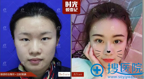 上海时光整形医院双眼皮案例对比图 上海时光整形医院双眼皮案例对比图