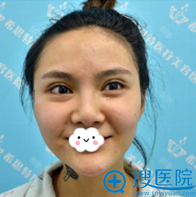 <!--<i data=20240710 data-id=9716></i>-->双眼皮术后即刻效果 <!--<i data=20240710 data-id=9716></i>-->双眼皮术后即刻效果