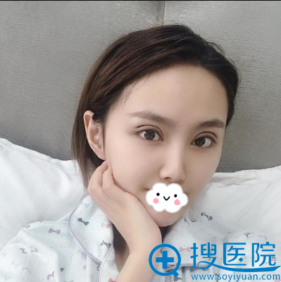 杨权明双眼皮修复术后2天恢复效果 杨权明双眼皮修复术后2天恢复效果