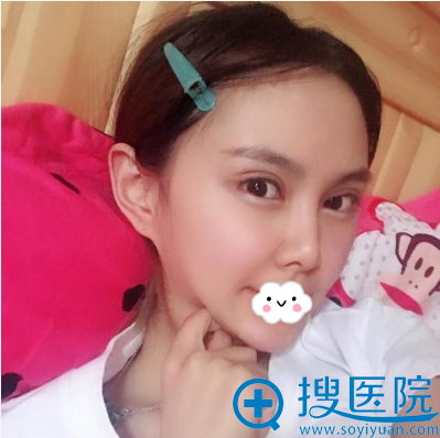 杨权明双眼皮修复术后素颜照片 杨权明双眼皮修复术后素颜照片