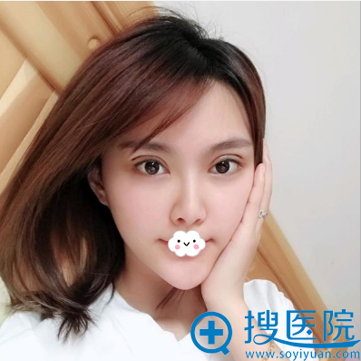 <!--<i data=20240710 data-id=9716></i>-->杨权明双眼皮修复术后 <!--<i data=20240710 data-id=9716></i>-->杨权明双眼皮修复术后
