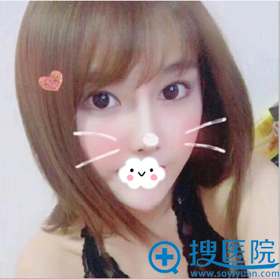 双眼皮修复手术术后3个月效果 双眼皮修复手术术后3个月效果