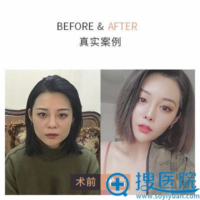 西安高一生金磊做的线雕提升一周后图片 西安高一生金磊做的线雕提升一周后图片