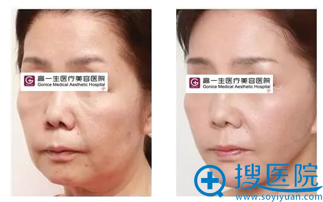 西安高一生金磊做的全脸线雕埋线提升案例 西安高一生金磊做的全脸线雕埋线提升案例