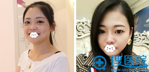 术后2年分享我在长沙美莱找邹俊峰做的自体耳软骨硅胶隆鼻效果