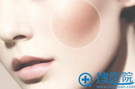 颧骨低怎样使颧骨增高?有哪些增高方法和手术费用是多少钱?