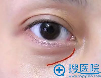 怎样去除下眼袋?眼袋一旦祛除成功还会复发吗?