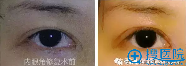 �����۽�ʧ���޸�����Ч��ͼ�Ա�