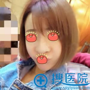 看我找合肥童颜堂周冬做假体隆鼻和鼻头鼻翼软骨矫正60天效果