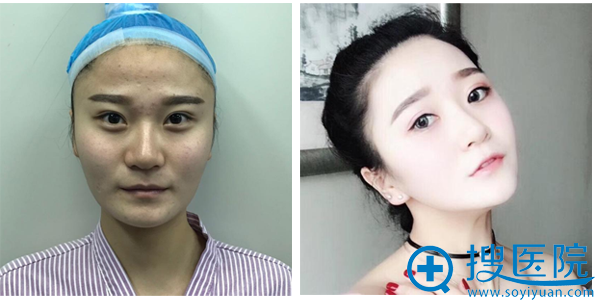 上海伊莱美李湘原做的颧骨内推案例对比图 上海伊莱美李湘原做的颧骨内推案例对比图