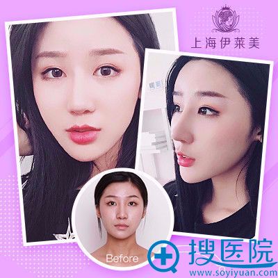 上海伊莱美颧骨内推真人案例 上海伊莱美颧骨内推真人案例