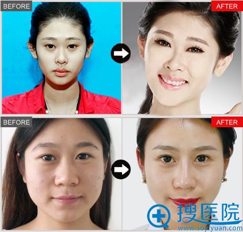 烟台壹美整形双眼皮和隆鼻案例 烟台壹美整形双眼皮和隆鼻案例