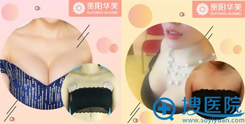 贵阳华美假体隆胸真人案例 贵阳华美假体隆胸真人案例