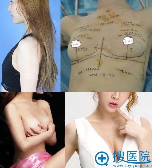 贵阳华美整形<!--<i data=20240710 data-id=16599></i>-->隆胸案例 贵阳华美整形<!--<i data=20240710 data-id=16599></i>-->隆胸案例