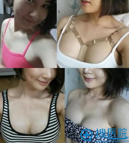 贵阳华美整形假体隆胸案例 贵阳华美整形假体隆胸案例