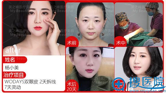 长沙美之峰解灿双眼皮案例 长沙美之峰解灿双眼皮案例