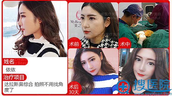 长沙美之峰丁翔鼻综合隆鼻案例 长沙美之峰丁翔鼻综合隆鼻案例