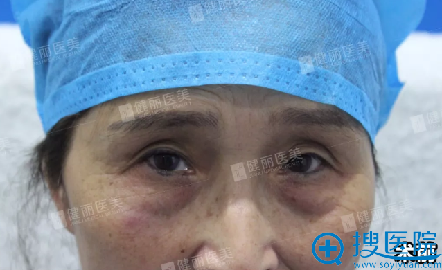 健丽医美去眼袋真人案例 健丽医美去眼袋真人案例