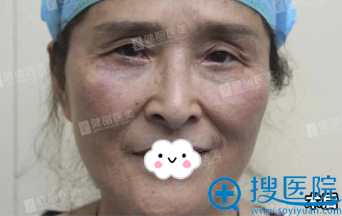 去眼袋术后真实效果图 去眼袋术后真实效果图