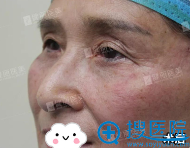 微创去眼袋效果怎么样? 微创去眼袋效果怎么样?