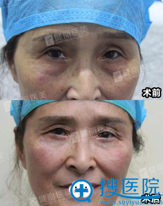 去眼袋有效的方法是什么 去眼袋有效的方法是什么