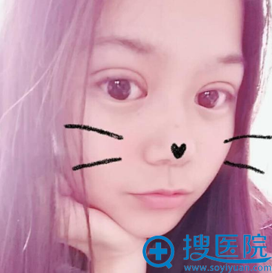 双眼皮术后一周效果图 双眼皮术后一周效果图